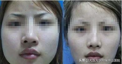 爱美变美小知识,爱美除皱针效果怎么样