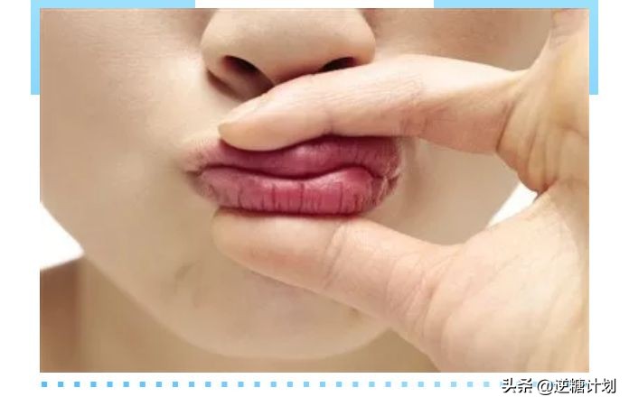 嘴唇口角干裂脱皮唇炎怎么办,成年人口角炎干裂最快治疗方法
