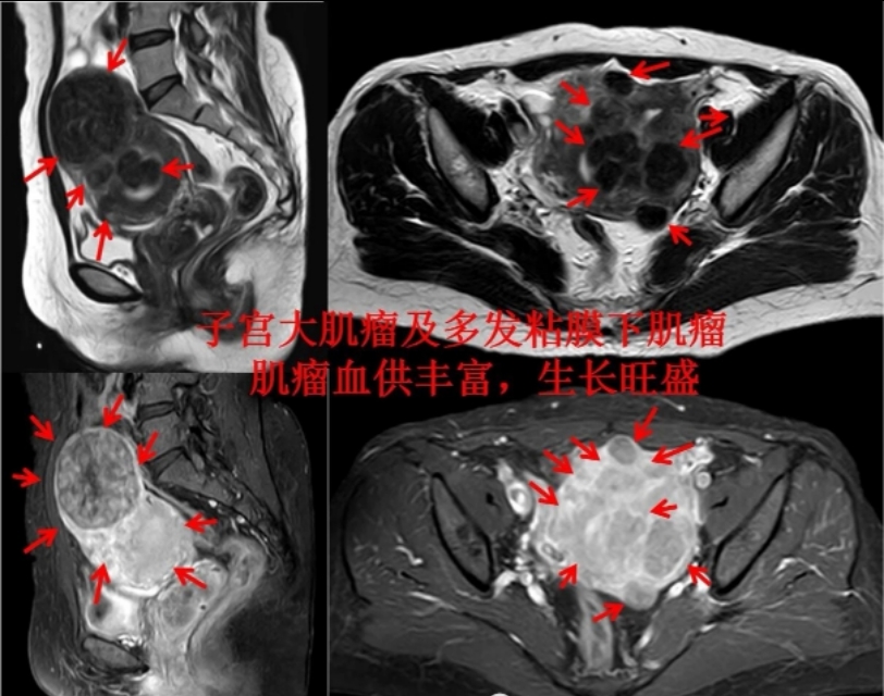 子宫肌瘤粘膜下肌瘤和肌壁间肌瘤,发现子宫肌瘤是大手术吗
