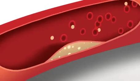 阿司匹林消化道出血的副作用,阿司匹林副作用出血怎么缓解