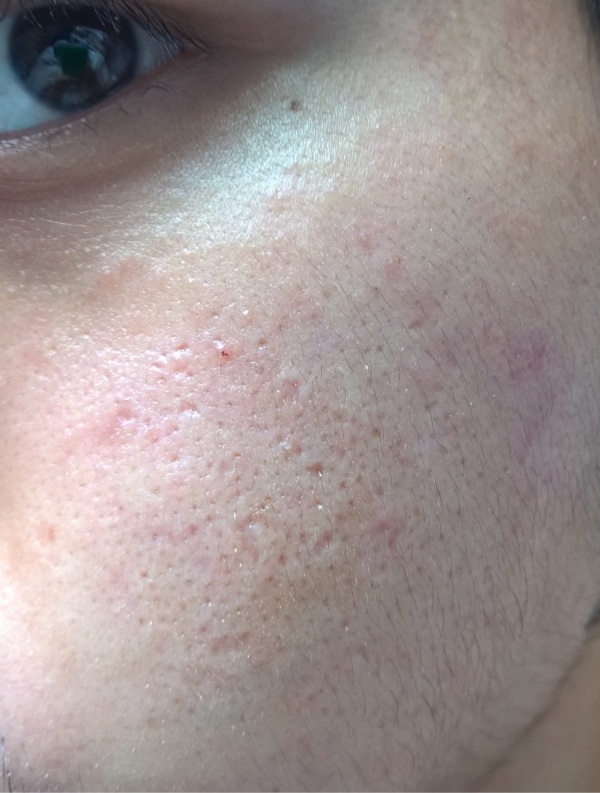 点阵激光能修复到什么程度,点阵激光凹陷疤痕能修复多少