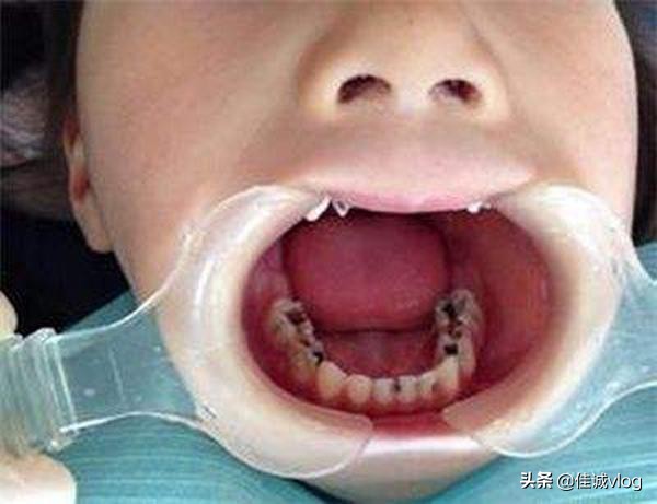 7岁小男孩牙疼哭,7岁孩子牙疼医生说不建议治疗