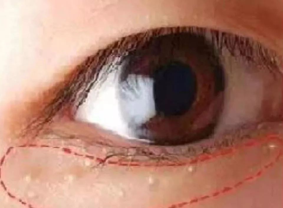 眼部脂肪粒有10多年了该怎么办,眼部脂肪粒不开刀四步解决