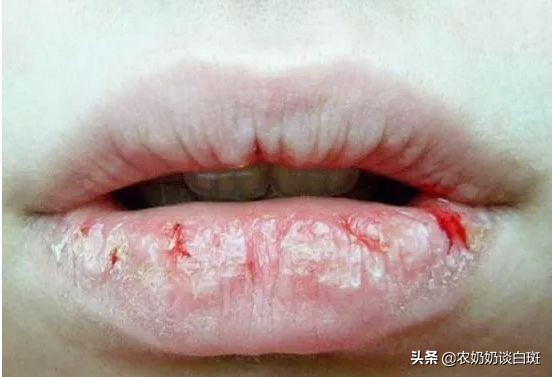 舔一舔：女子变烈焰红唇？白癜风在嘴巴上来回跳跃