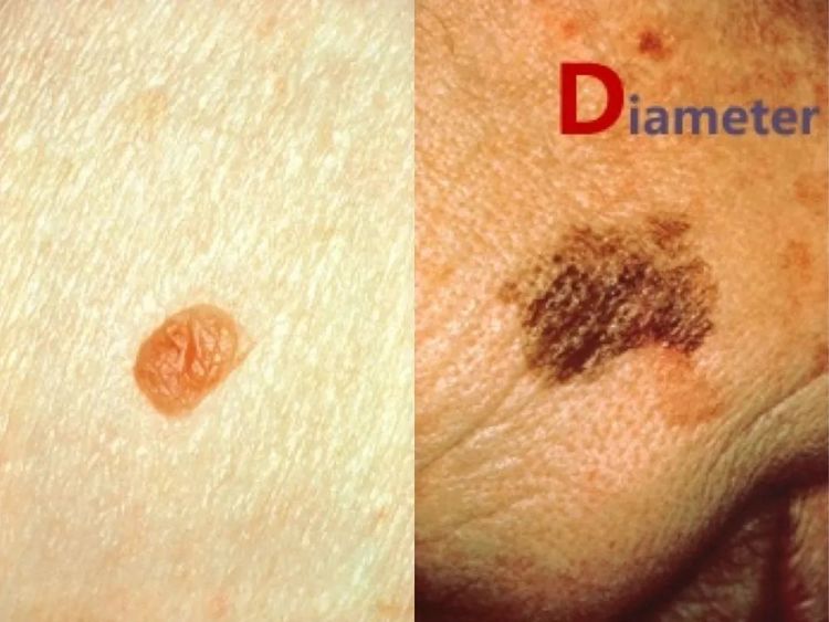 激光点痣不小心照了紫灯怎么办,切除黑色素痣可能癌变吗