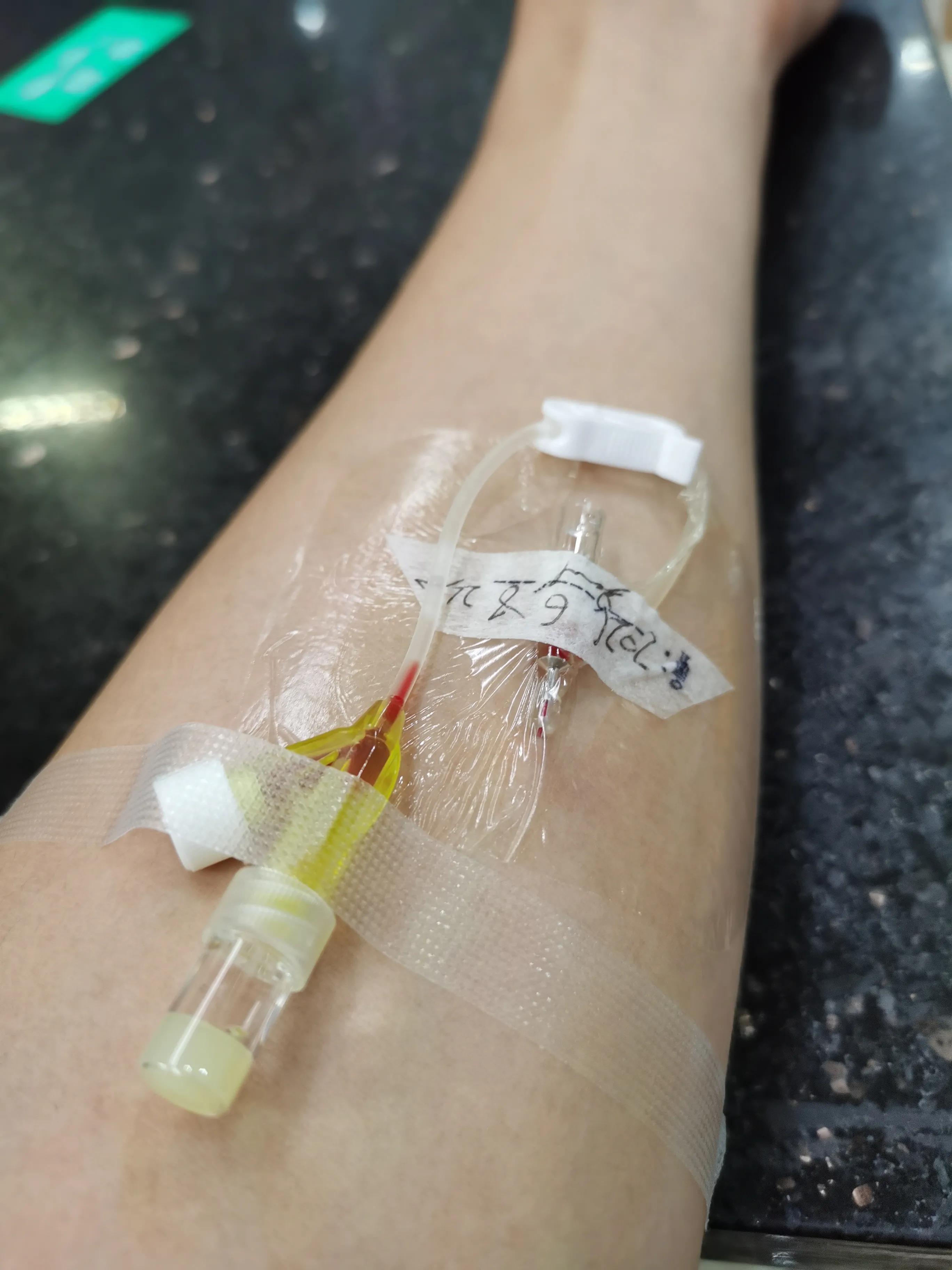 第五跖骨粉碎性骨折多久后能走路,第五跖骨基底骨折100天了走路肿