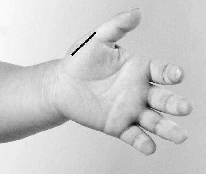 过敏性鼻炎推拿有效果吗,小宝宝过敏性鼻炎怎么推拿