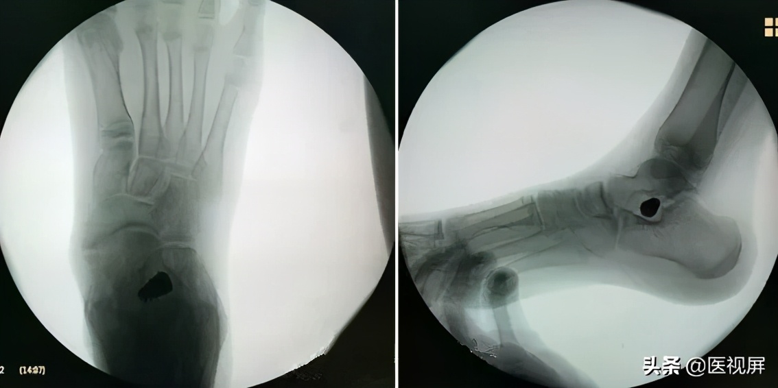 17岁平足症怎么治疗,青少年平足怎么办
