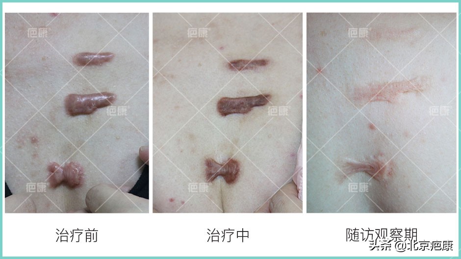 怎么判断瘢痕疙瘩是否复发,瘢痕疙瘩如何彻底治愈