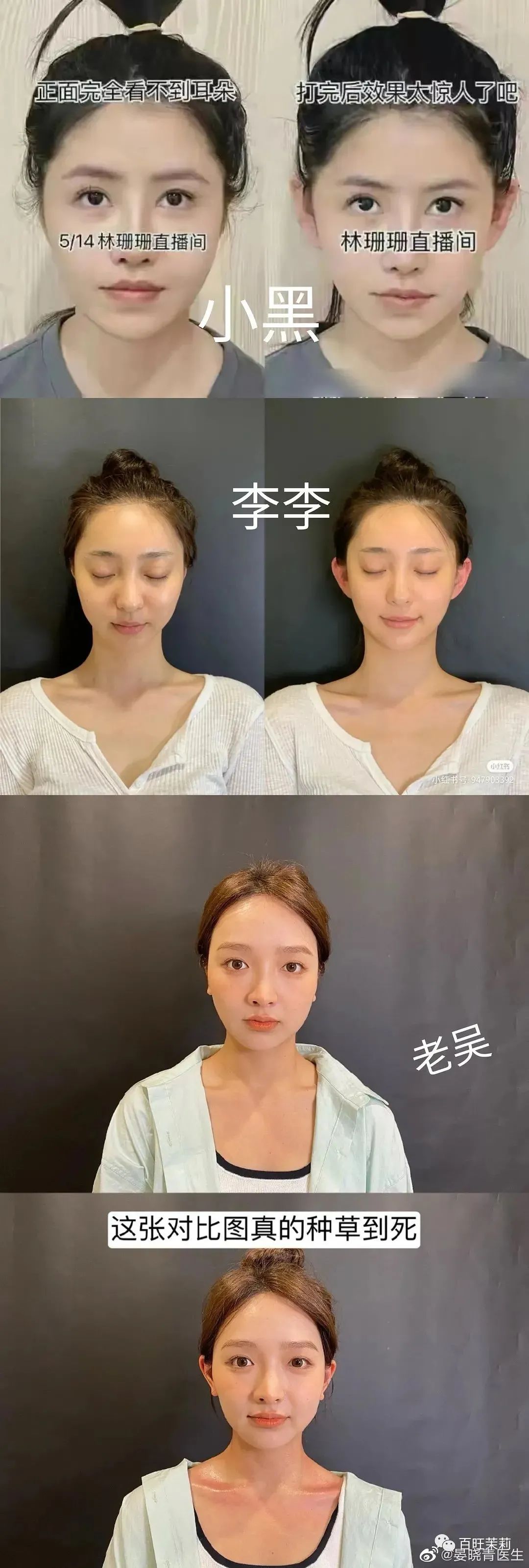 挑筋断骨切胃，那些为了美不要命的女人到底有多可怕