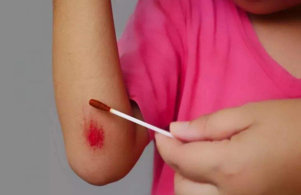 不小心擦破皮,怎么样处理才合适?分辨5个妙招,伤口不发炎