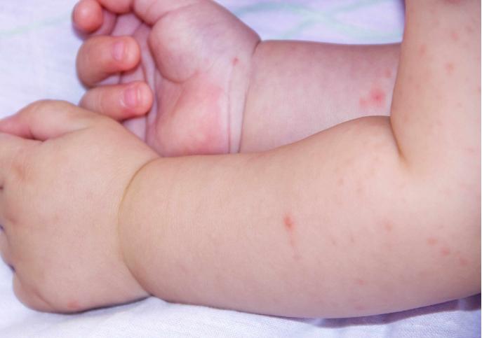 湿疹反复折磨宝宝要应对有妙招,湿疹留下好多坑