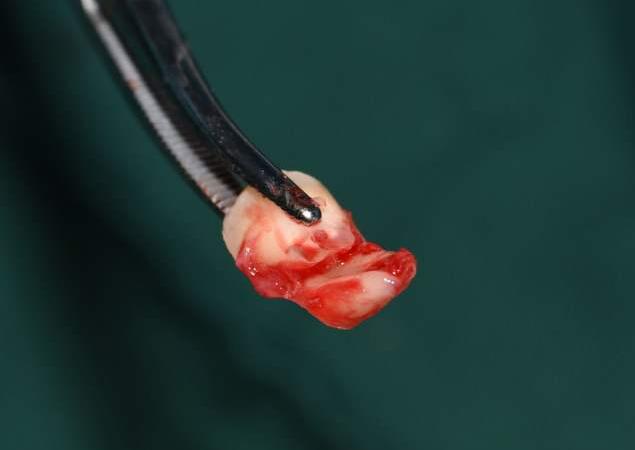 拔智齿断的一点在里面没有关系吗,拔智齿断了牙根留在里面如何处理