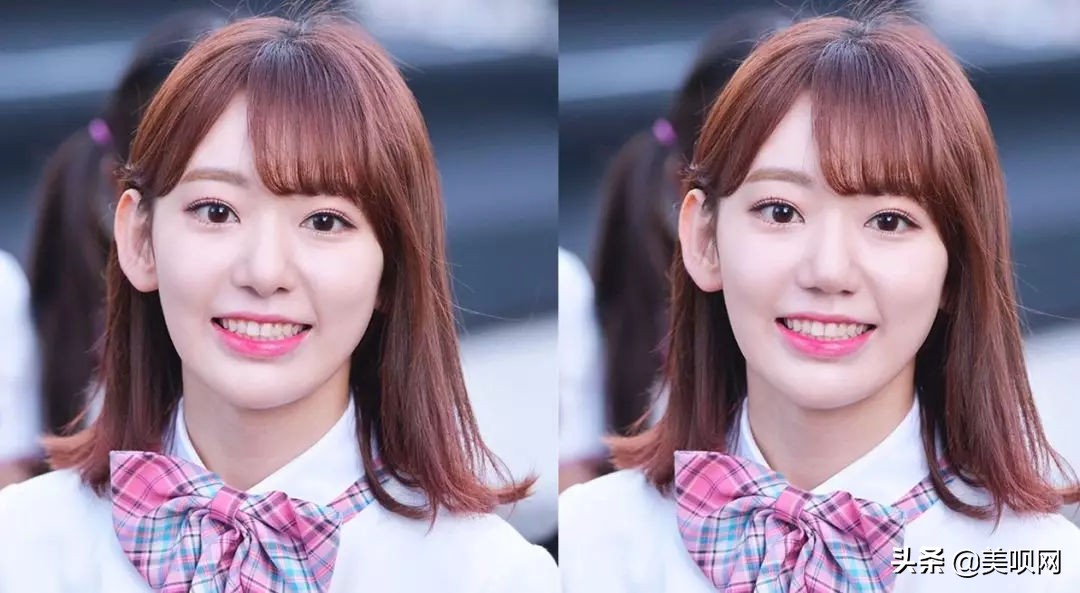 明星都在用的缩小鼻翼神器,明星鼻子做鼻翼缩小外切