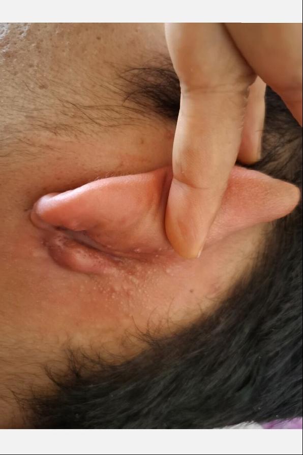 “马刀侠瘿”——长在三焦经上的瘤子