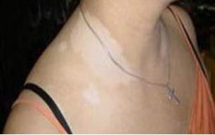 不要这样“变美”:22岁女孩为美白进行代购,因使用不当患白癜风