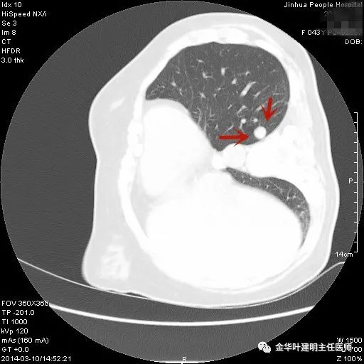 叶建明谈实性结节,叶建明肺实性良性结节会变癌症吗