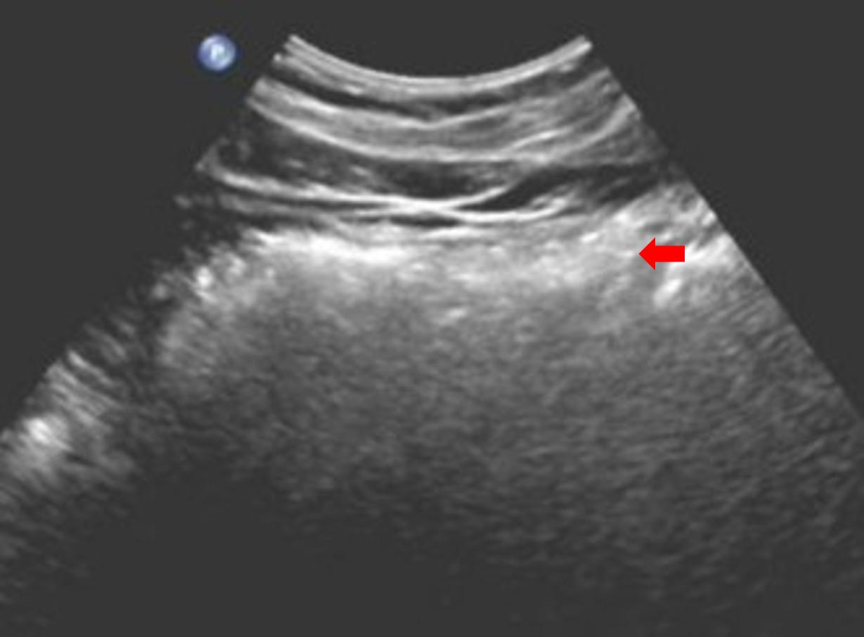 空腹做彩超能检查出什么,彩超为什么检查肝要空腹