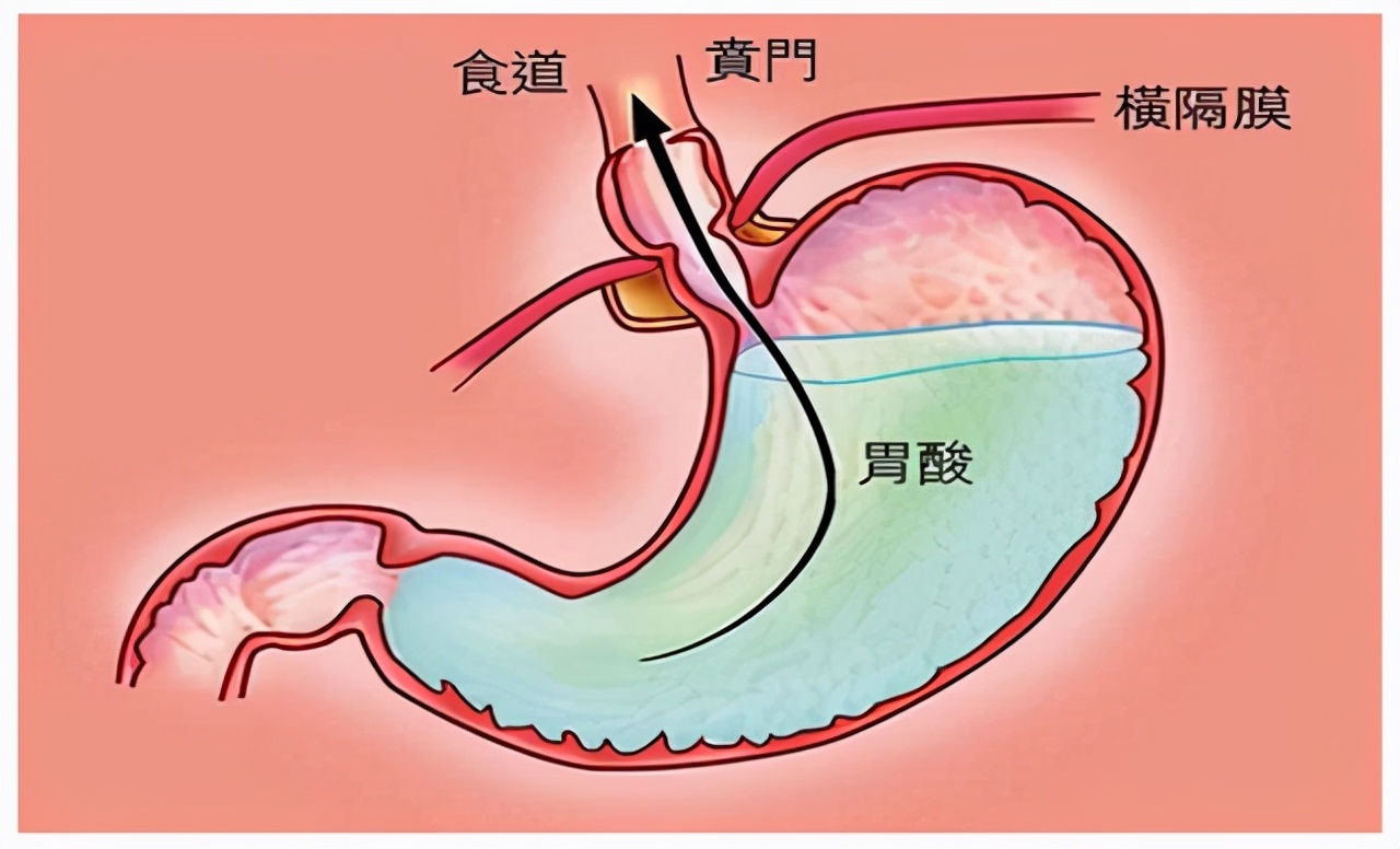 总是反酸烧心，十有八九是这个病！很多人以为是慢性咽炎