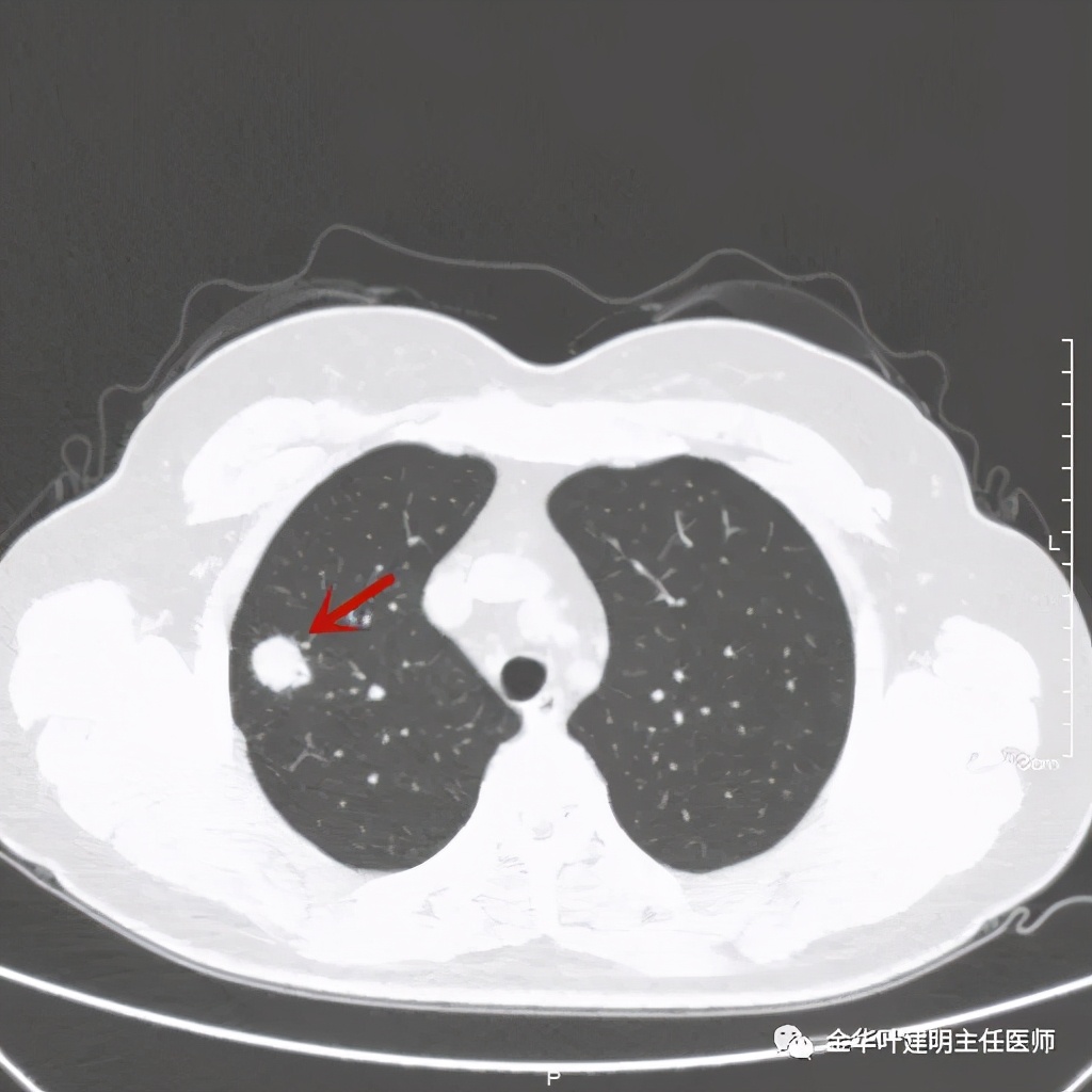 右上肺结节灶一般是什么癌,右上肺恶性肿瘤是肺癌吗