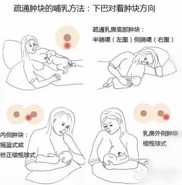 宝妈乳房胀痛不通奶怎么办,宝妈乳房堵奶怎么处理