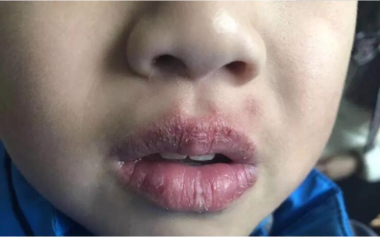 小孩长期嘴唇干裂起皮还出血,儿童嘴唇起皮干裂出血怎么办
