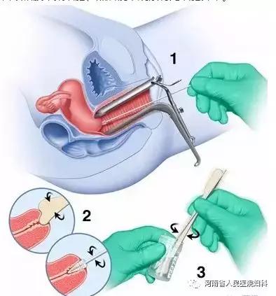你知道什么是宫颈糜烂吗？