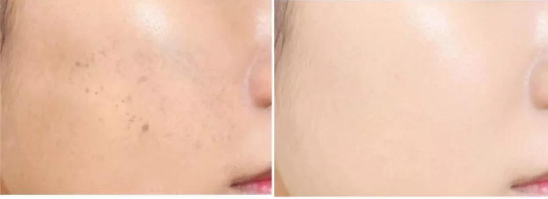 平价淡斑美白小灯泡,神仙水小灯泡精华淡斑