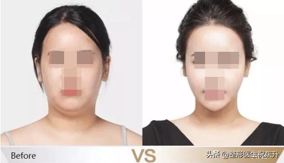 双下巴、脖子粗,又丑又显老,如何减掉双下巴?