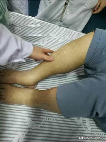 水肿下肢无力中医治疗处方,中医治疗老年人水肿的方法