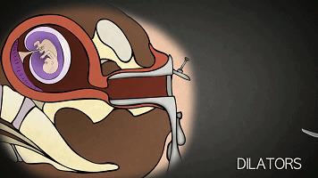 堕胎手术到底有多可怕,堕胎手术可怕的真相