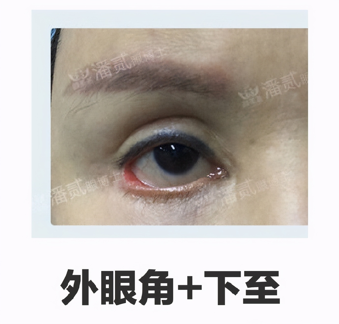 开内眼角失败留疤了怎么办,开外眼角恢复期间会有紧绷感么