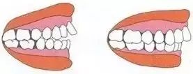 三岁孩子矫正牙齿后又反复,孩子牙齿矫正一个月看不到效果