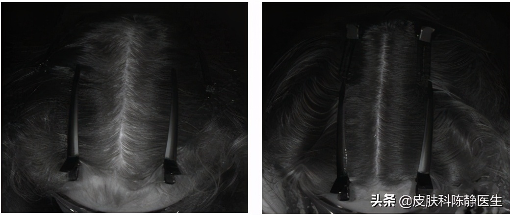 治疗雄激素脱发的生物制剂,女性脱发常用药螺内酯