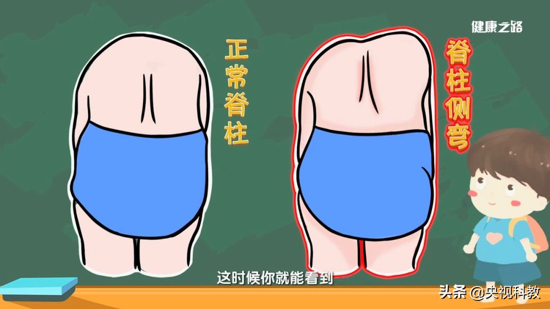 小孩驼背怎么矫正过来,孩子驼背可以按回去吗