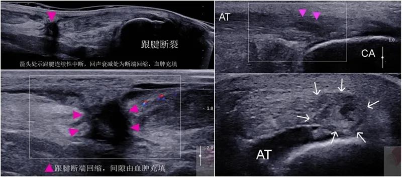 跟腱断裂术后康复训练,跟腱断裂恢复的小偏方