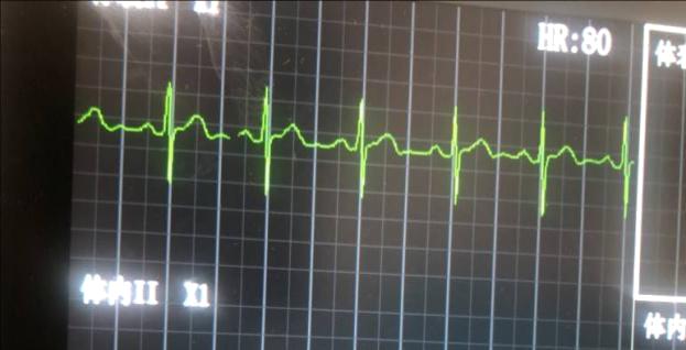 开展picc置管技术,隧道式picc置管技术专家共识