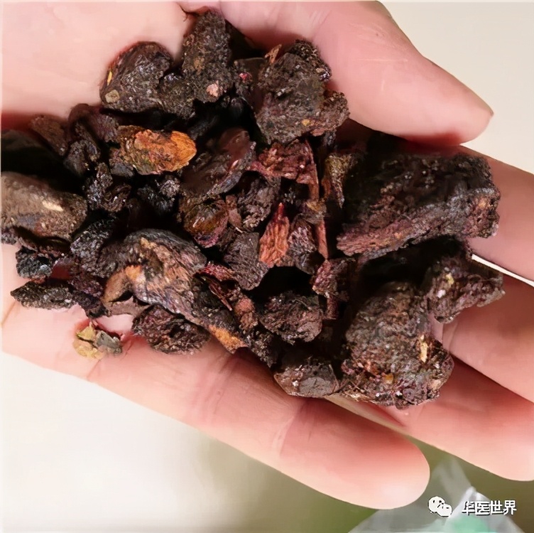 最好的中医治疗卵巢巧克力囊肿,卵巢巧克力囊肿治疗的好方法