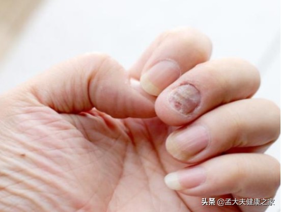 得了灰指甲怎么办才能治好,得了灰指甲怎样才能彻底治疗呢