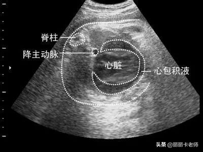 心包积液日常饮食注意些什么,心包积液打白蛋白有效吗