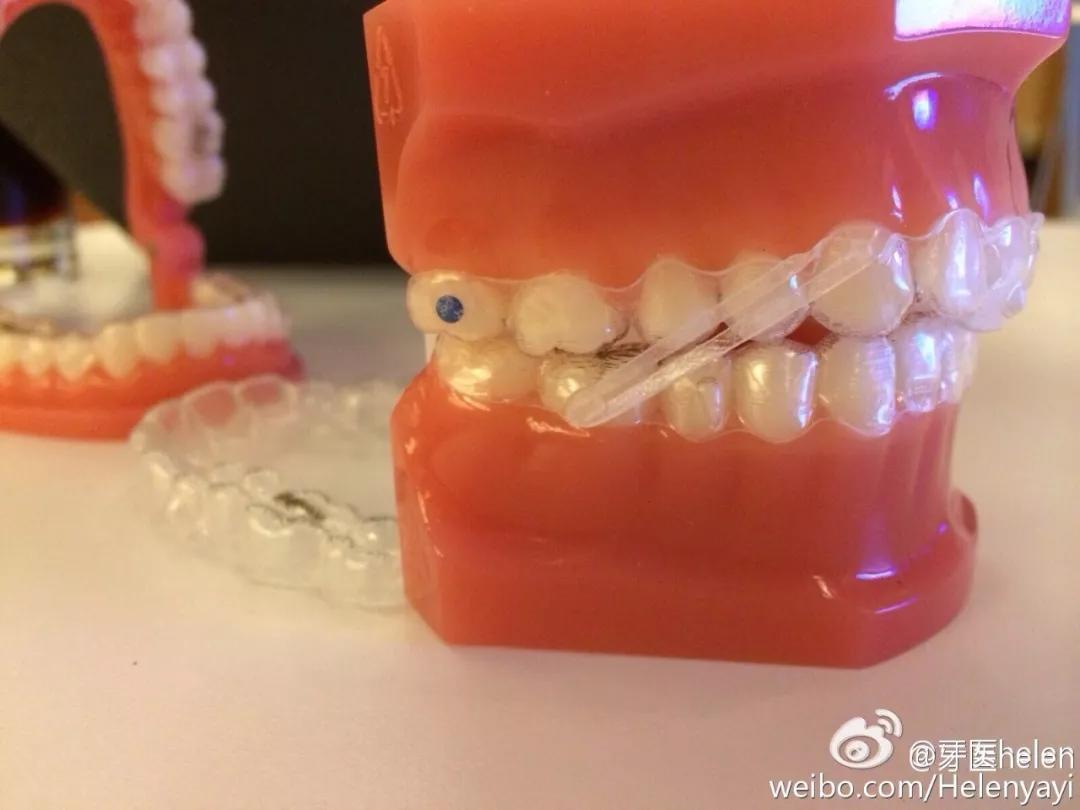 隐形矫正的不适应症,隐形矫正眼镜能看到什么