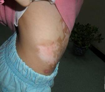 治白癜风很简单用它补黑色素,调理白癜风