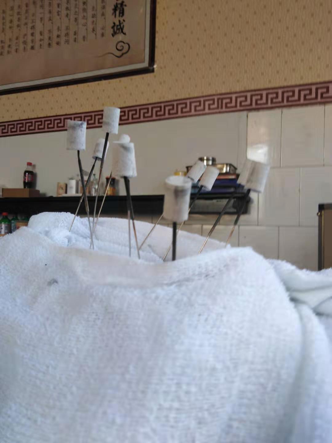 诊所扎针出事,扎针医疗事故