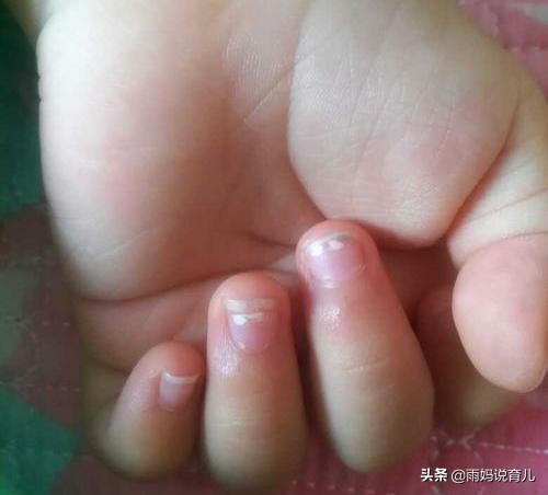 指甲白色缺钙,指甲盖上有白点是有蛔虫的意思吗