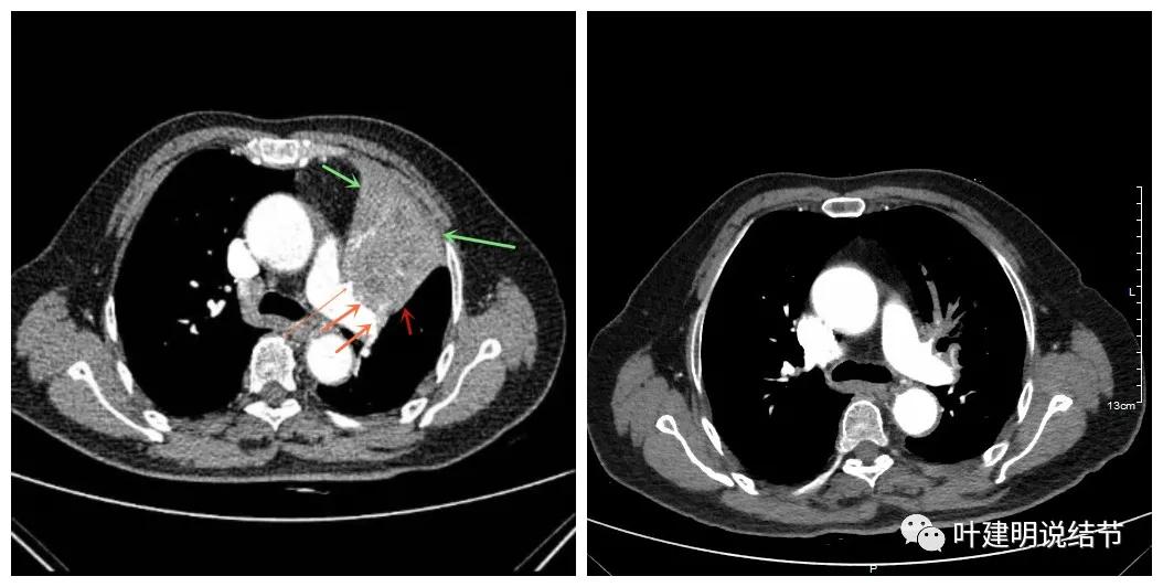 卡瑞利珠单抗治疗肺鳞癌有用吗,特瑞普利单抗对鳞癌治疗有效吗
