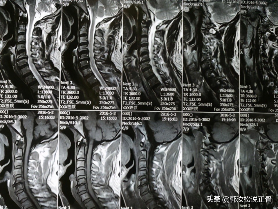 颈椎病引发头晕走路不稳怎么治,颈椎病引起头晕走路不稳怎么办