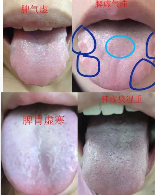 喝粥调理脾胃,喝粥湿气重怎么办