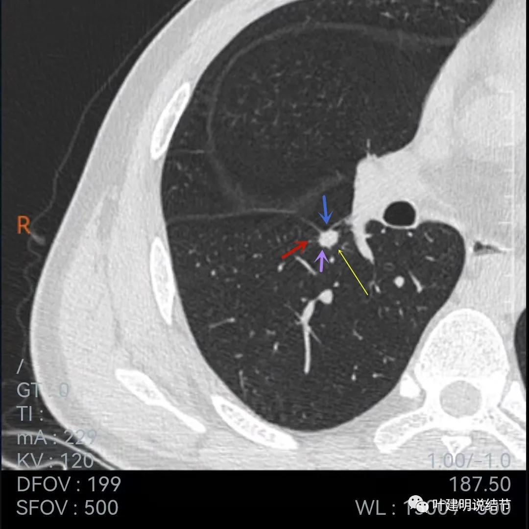 问诊分析：存在了4年的实性结节会不会是肺癌？