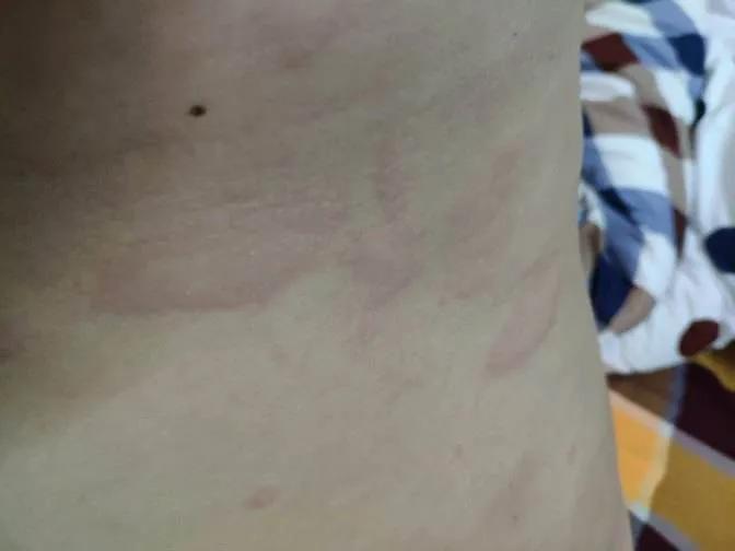 儿童荨麻疹反复发作三招教你搞定,慢性儿童荨麻疹最简单自愈方法