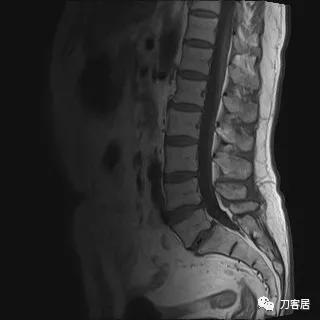 小针刀扎到坐骨神经会瘫痪吗,小针刀会切断坐骨神经吗